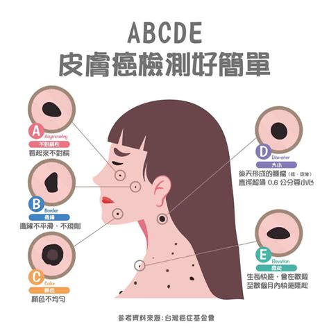 臉頰長痣|皮膚長痣、長斑是皮膚癌前兆？皮膚癌初期4大症狀快。